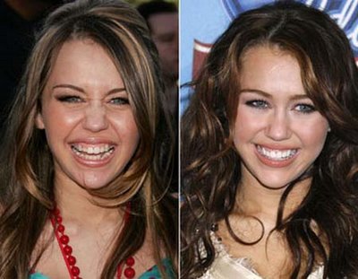 miley-cyrus-veneer1